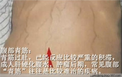 76個中藥外敷肚臍偏方【非常實用】 - 民間骨膜修復專家 - 青島葉氏三位一體正骨揉筋針灸術
