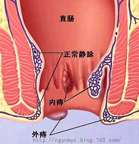 用清涼油治鼻息肉和肛外痔有奇效 - 月  月 - 陽光月月(看新聞)