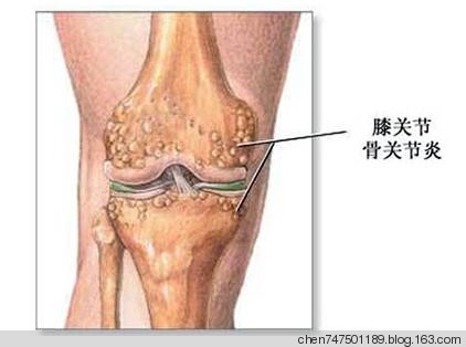 “針刀松解術”治療骨性關節炎 - 真善美 - chen747501189